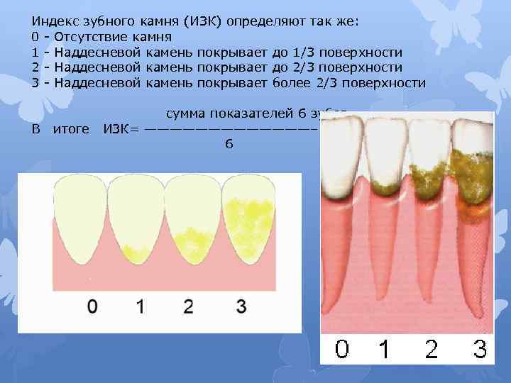 Индекс зубного камня (ИЗК) определяют так же: 0 Отсутствие камня 1 Наддесневой камень покрывает