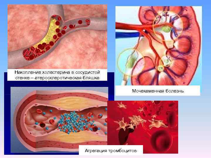 Накопление холестерина в сосудистой стенке – атеросклеротическая бляшка Мочекаменная болезнь Агрегация тромбоцитов 