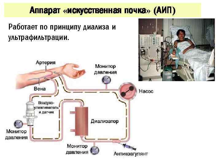 Аппарат «искусственная почка» (АИП) Работает по принципу диализа и ультрафильтрации. 