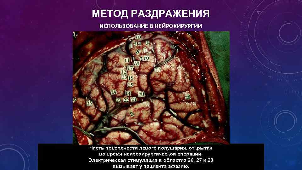 МЕТОД РАЗДРАЖЕНИЯ ИСПОЛЬЗОВАНИЕ В НЕЙРОХИРУРГИИ Часть поверхности левого полушария, открытая во время нейрохирургической операции.