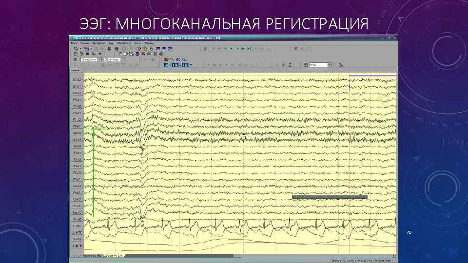 ЭЭГ: МНОГОКАНАЛЬНАЯ РЕГИСТРАЦИЯ 70 