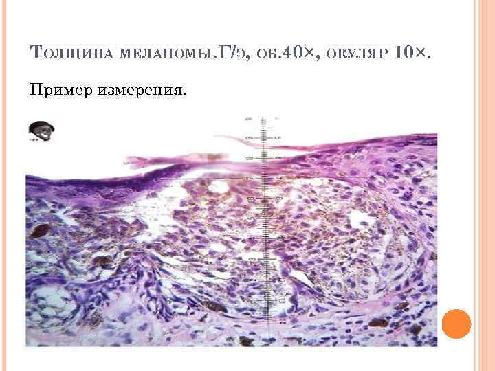 ТОЛЩИНА МЕЛАНОМЫ. Г/Э, ОБ. 40×, ОКУЛЯР 10×. Пример измерения. 