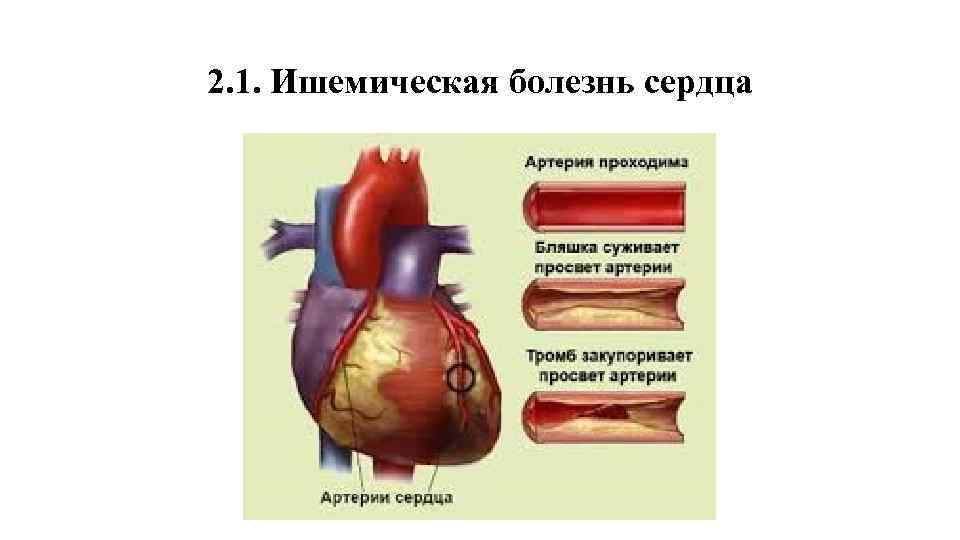 2. 1. Ишемическая болезнь сердца 