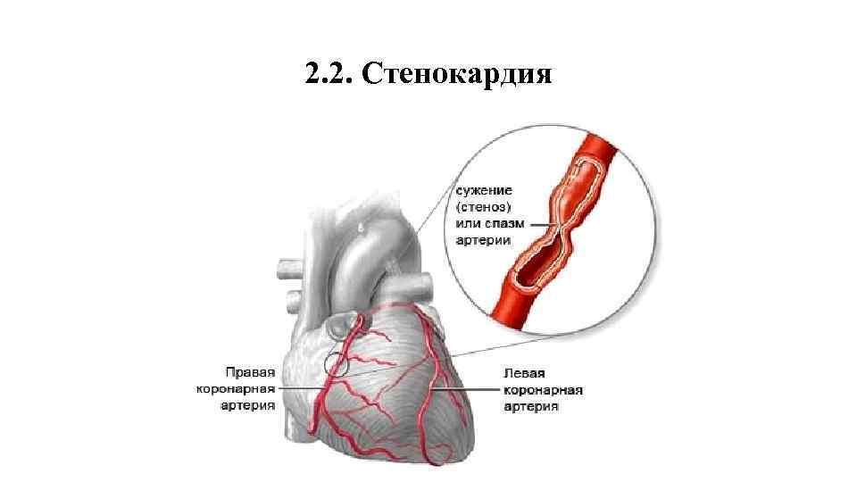 2. 2. Стенокардия 
