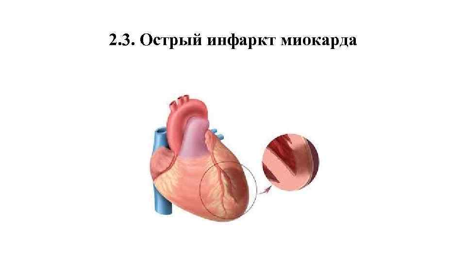 2. 3. Острый инфаркт миокарда 