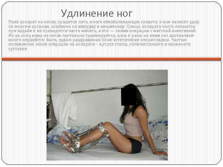 Удлинение ног Пока аппарат на ногах, придется пить много обезболивающих средств, а они наносят