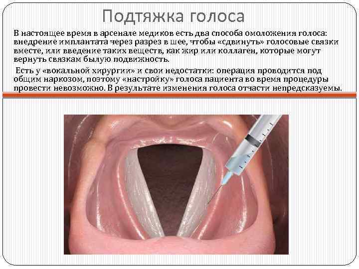 Подтяжка голоса В настоящее время в арсенале медиков есть два способа омоложения голоса: внедрение