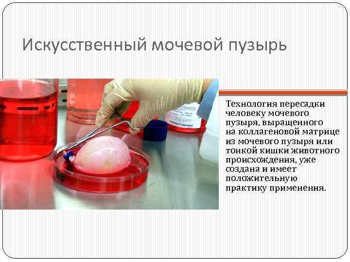Искусственный мочевой пузырь Технология пересадки человеку мочевого пузыря, выращенного на коллагеновой матрице из мочевого