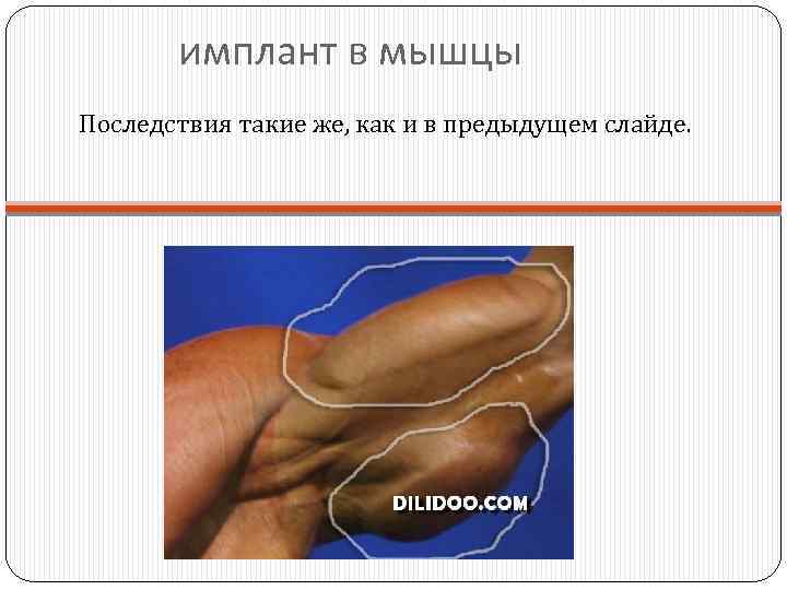 имплант в мышцы Последствия такие же, как и в предыдущем слайде. 