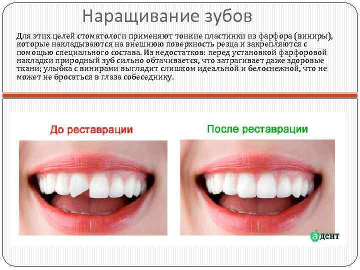 Наращивание зубов Для этих целей стоматологи применяют тонкие пластинки из фарфора (виниры), которые накладываются