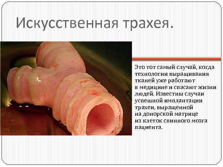Искусственная трахея. Это тот самый случай, когда технологии выращивания тканей уже работают в медицине