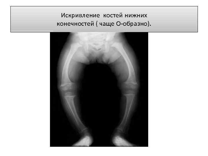 Искривление костей нижних конечностей ( чаще О-образно). 