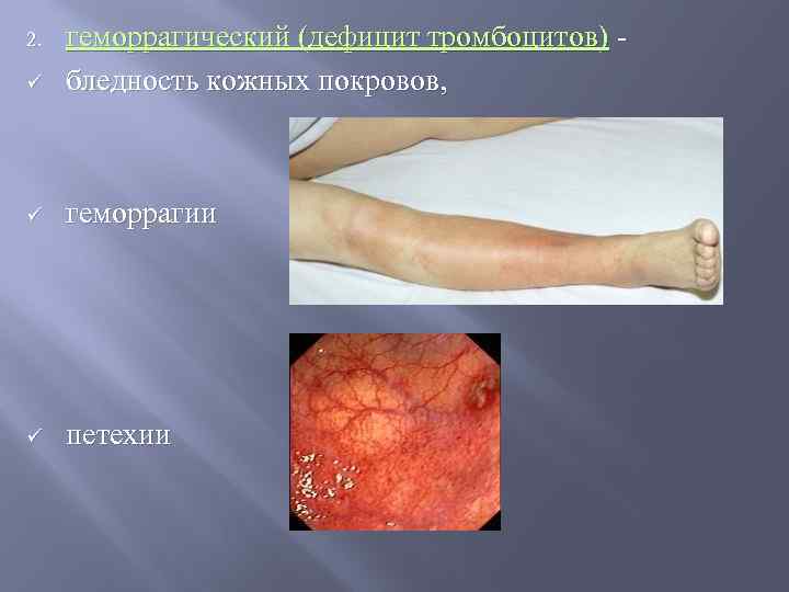 ü геморрагический (дефицит тромбоцитов) бледность кожных покровов, ü геморрагии ü петехии 2. 