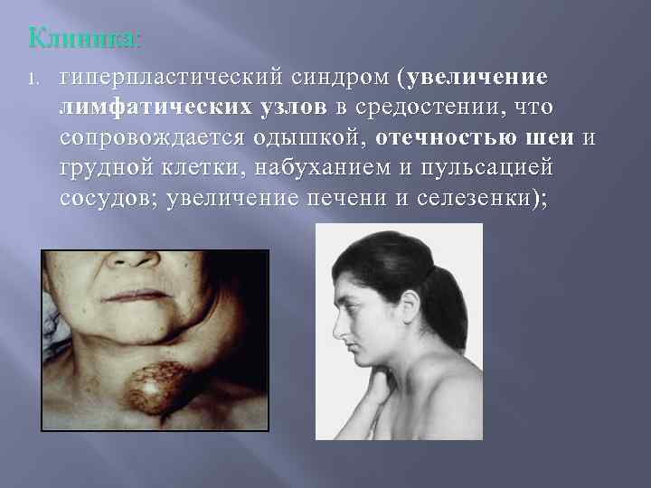 Клиника: 1. гиперпластический синдром ( увеличение лимфатических узлов в средостении, что сопровождается одышкой, отечностью