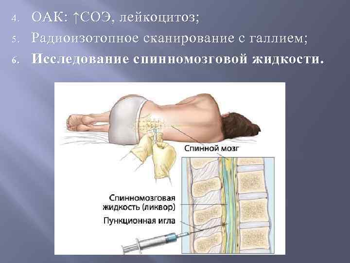 4. 5. 6. ОАК : ↑СОЭ, лейкоцитоз; Радиоизотопное сканирование с галлием; Исследование спинномозговой жидкости.