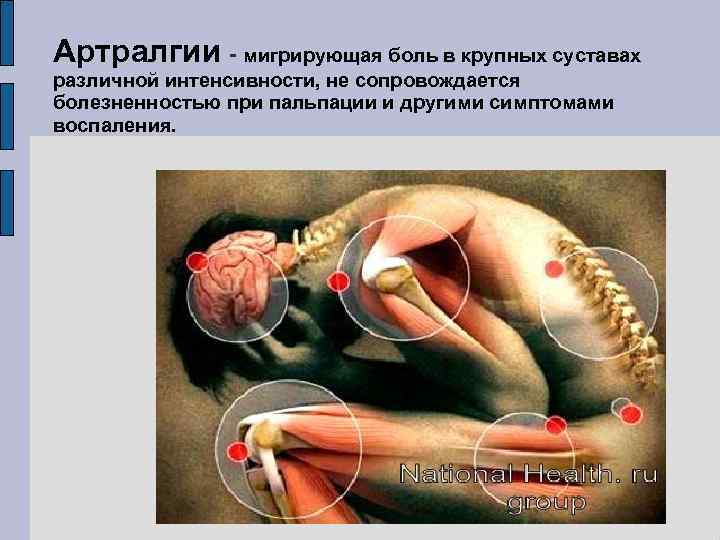 Артралгии - мигрирующая боль в крупных суставах различной интенсивности, не сопровождается болезненностью при пальпации