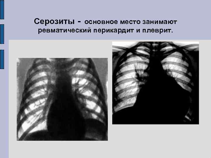 Серозиты - основное место занимают ревматический перикардит и плеврит. 