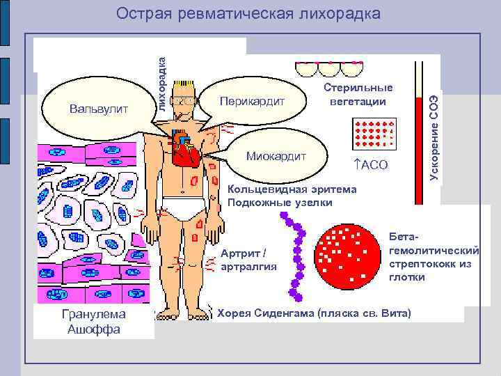 Перикардит Миокардит Стерильные вегетации АСО Ускорение СОЭ Вальвулит лихорадка Острая ревматическая лихорадка Кольцевидная эритема
