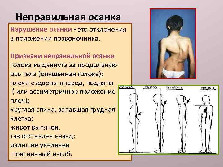 Неправильная осанка Нарушение осанки это отклонения в положении позвоночника. Признаки неправильной осанки голова выдвинута