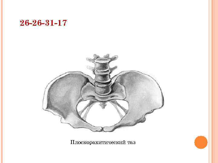 26 -26 -31 -17 Плоскорахитический таз 