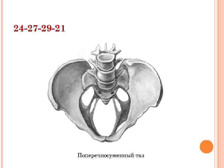 24 -27 -29 -21 Поперечносуженный таз 