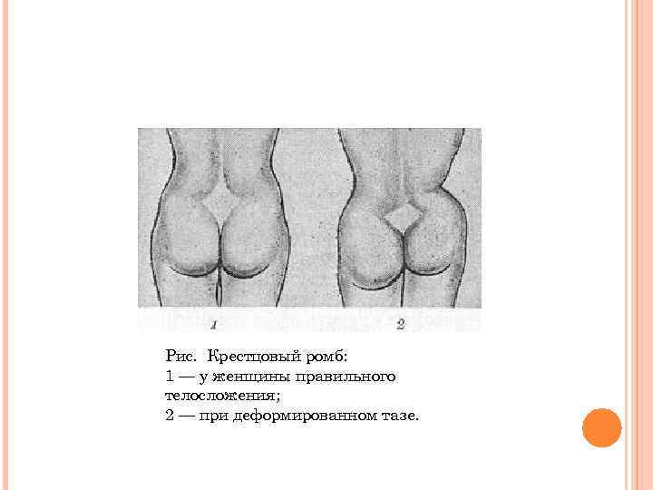 Рис. Крестцовый ромб: 1 — у женщины правильного телосложения; 2 — при деформированном тазе.