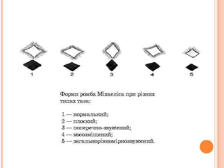 Форми ромба Міхаеліса при різних типах таза: 1 — нормальний; 2 — плоский; 3