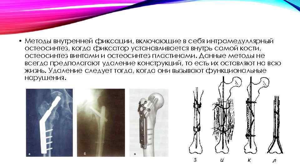 Интрамедуллярный остеосинтез плечевой кости