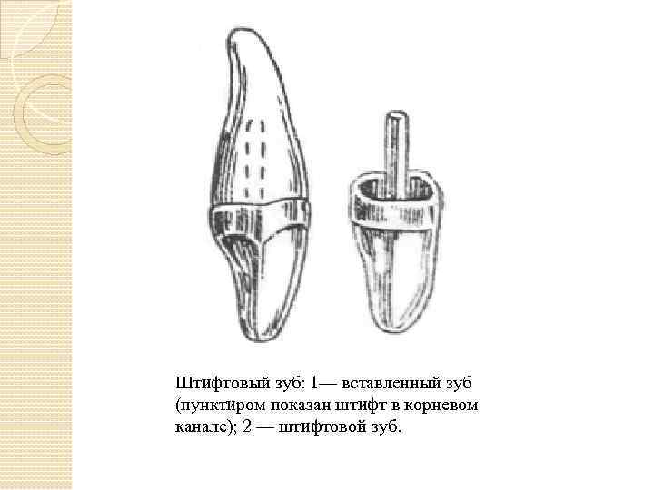 Штифтовые зубы презентация