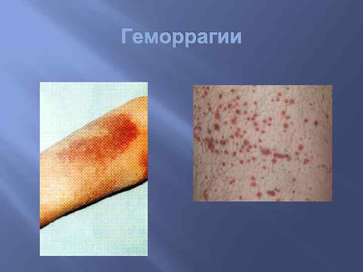 Геморрагии 