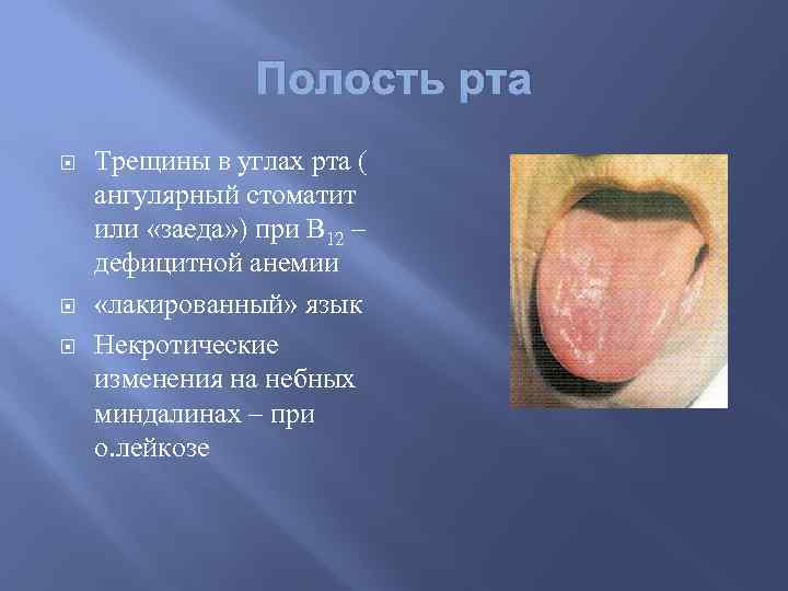 Полость рта Трещины в углах рта ( ангулярный стоматит или «заеда» ) при В