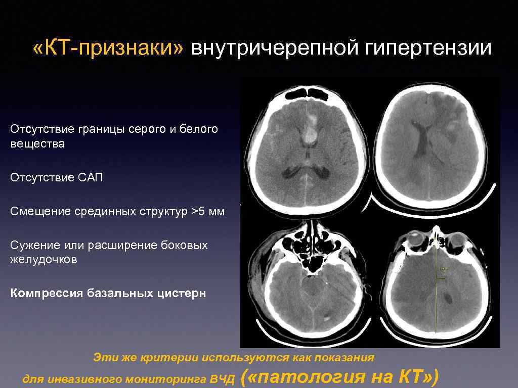Причины сужения головного мозга