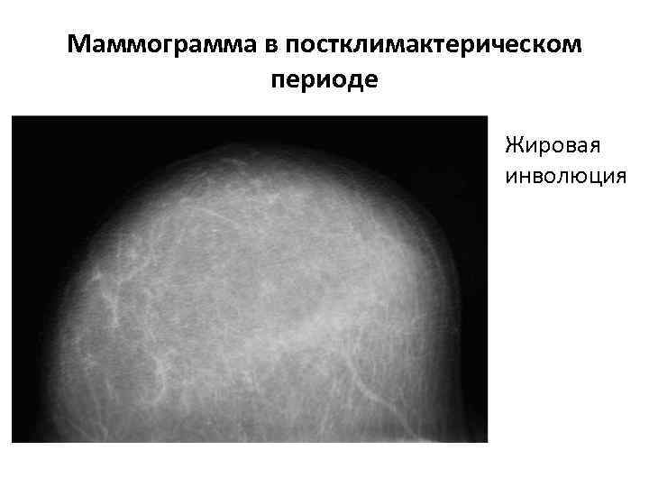 Жировая инволюция молочной железы