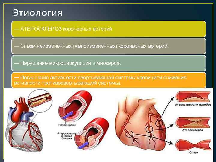 Ибс атеросклероз кардиосклероз. ИБС атеросклероз коронарных артерий. Атеросклероз коронарных сосудов патогенез. Спазм коронарных артерий патогенез. Атеросклероз коронарных артерий патогенез.