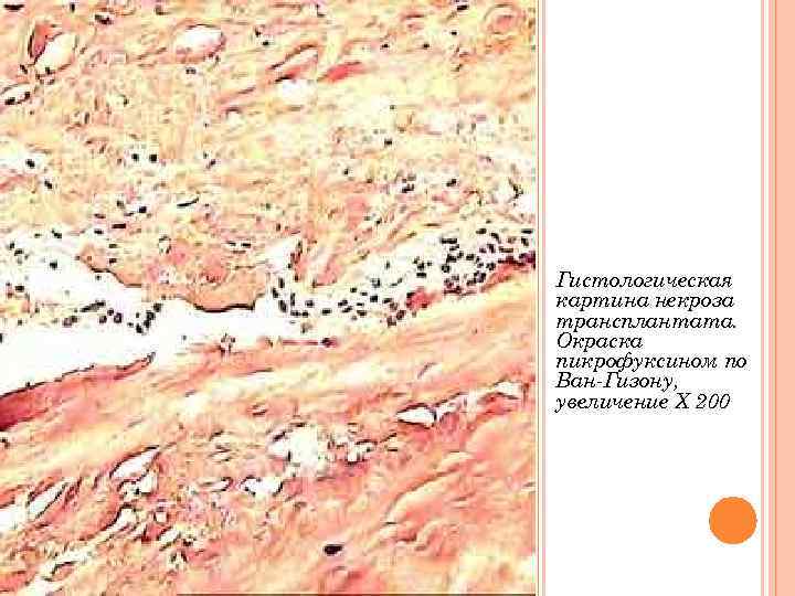 Гистологическая картина некроза трансплантата. Окраска пикрофуксином по Ван-Гизону, увеличение Х 200 