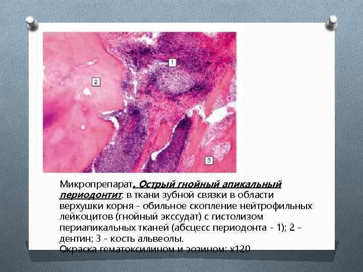 Микропрепарат. Острый гнойный апикальный периодонтит: в ткани зубной связки в области верхушки корня -