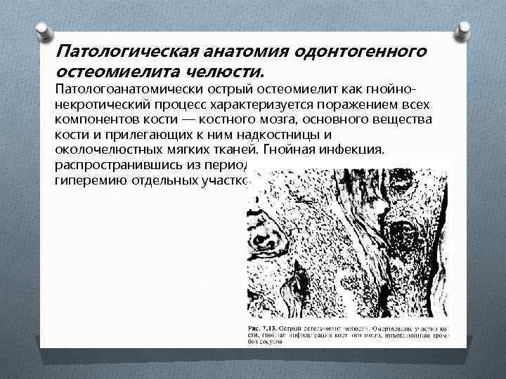 Патологическая анатомия одонтогенного остеомиелита челюсти. Патологоанатомически острый остеомиелит как гнойнонекротический процесс характеризуется поражением всех