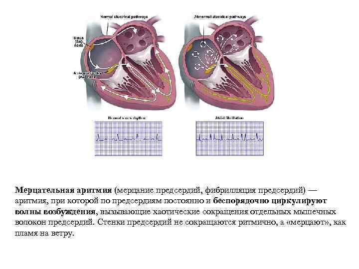 Мерцательная аритмия (мерцание предсердий, фибрилляция предсердий) — аритмия, при которой по предсердиям постоянно и