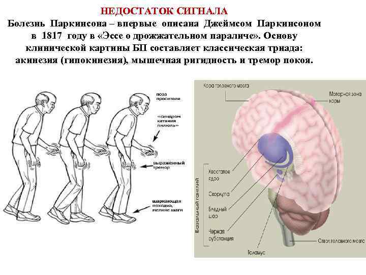 НЕДОСТАТОК СИГНАЛА Болезнь Паркинсона – впервые описана Джеймсом Паркинсоном в 1817 году в «Эссе