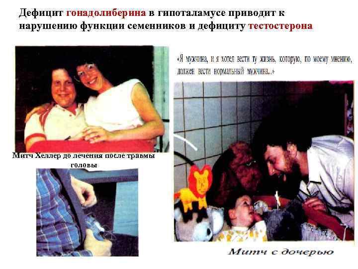 Дефицит гонадолиберина в гипоталамусе приводит к нарушению функции семенников и дефициту тестостерона Митч Хеллер