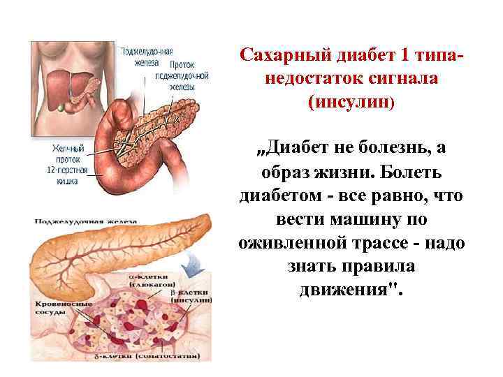 Сахарный диабет 1 типа- недостаток сигнала (инсулин) „Диабет не болезнь, а образ жизни. Болеть