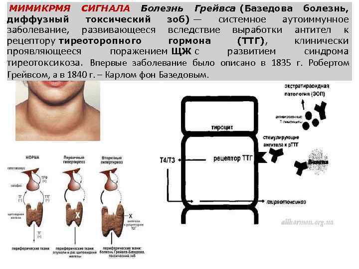 МИМИКРМЯ СИГНАЛА Болезнь Грейвса (Базедова болезнь, диффузный токсический зоб) — системное аутоиммунное заболевание, развивающееся