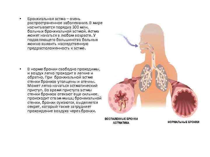  • Бронхиальная астма – очень распространенное заболевание. В мире насчитывается порядка 300 млн.