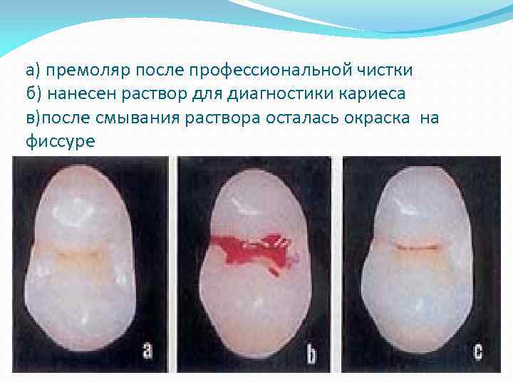 а) премоляр после профессиональной чистки б) нанесен раствор для диагностики кариеса в)после смывания раствора