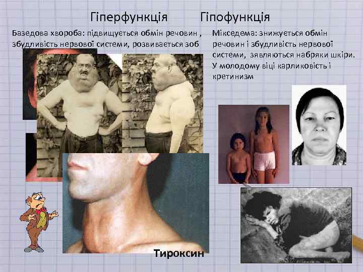 Гіперфункція Гіпофункція Базедова хвороба: підвищується обмін речовин , збудливість нервової системи, розвивається зоб Тироксин
