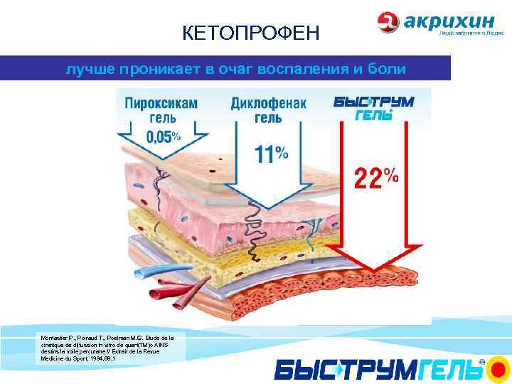 КЕТОПРОФЕН лучше проникает в очаг воспаления и боли Montastier P. , Poiraud Т. ,