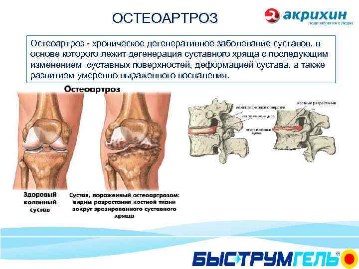 Остеоартроз карта вызова