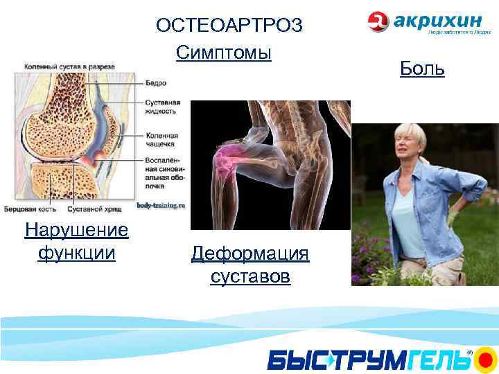 ОСТЕОАРТРОЗ Симптомы Нарушение функции Деформация суставов Боль 