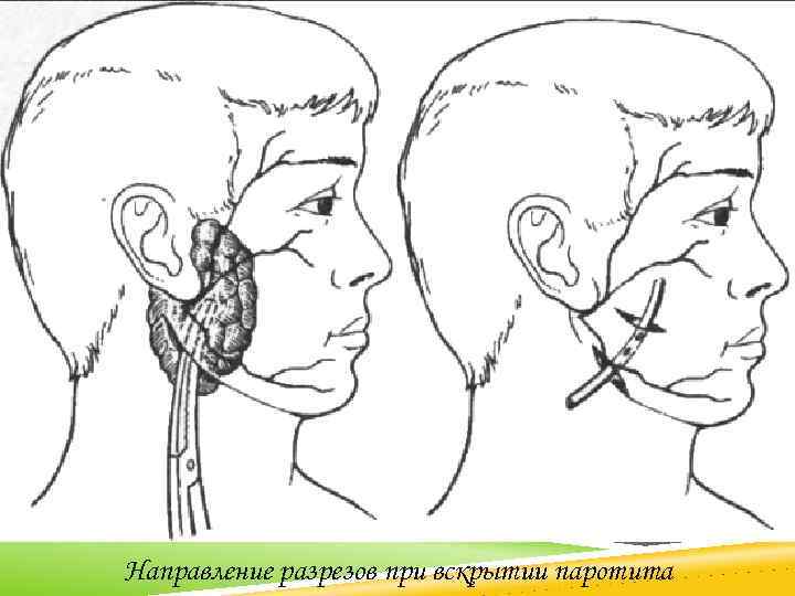 Направление разрезов при вскрытии паротита 