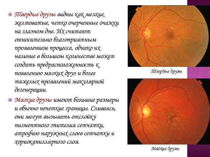 Твердые друзы видны как мелкие, желтоватые, четко очерченные очажки на глазном дне. Их считают